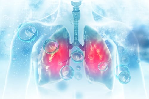 Lung infection medical malpractice